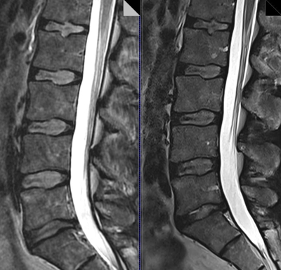 RM Col. lumbar