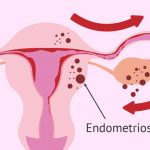 Endometriosis | Proimagem